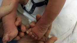 Çocuklarda düztabanlığın 4 önemli sinyali göz ardı edilmemeli