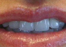 Diş Estetiği Uygulamalarının Kalıcı Olması Ağız Hijyenine Ve Diş Hekimine Bağlı