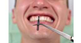 Kemik yetersizliğinde implant tedavisi mümkün