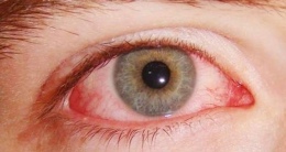 Kış Aylarında Göz Enfeksiyonlarında Artış Uyarısı