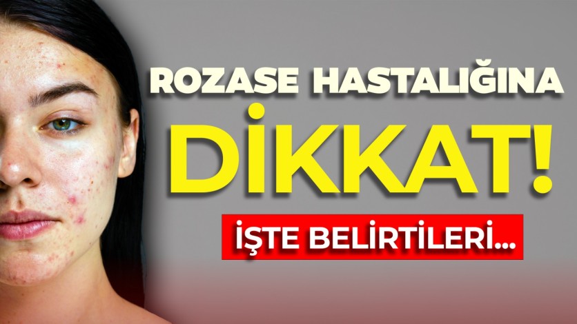 Rozase hastalığı en çok kadınlarda ve açık tenlilerde görülüyor