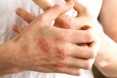 Soğuk havalarda en çok görülen cilt hastalıkları   