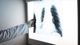 Zatürre Hâlâ Yüksek Ölüm Oranlarına Sahip Bir Hastalık